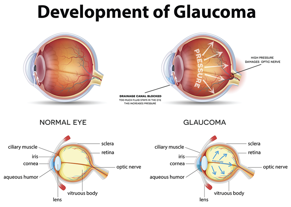 Glaucoma - Diagram Showing A Healthy Eye Vs. A Diseased Eye