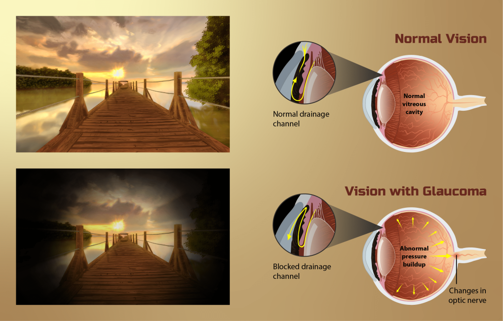 Depiction of Vision for a Glaucoma Patient