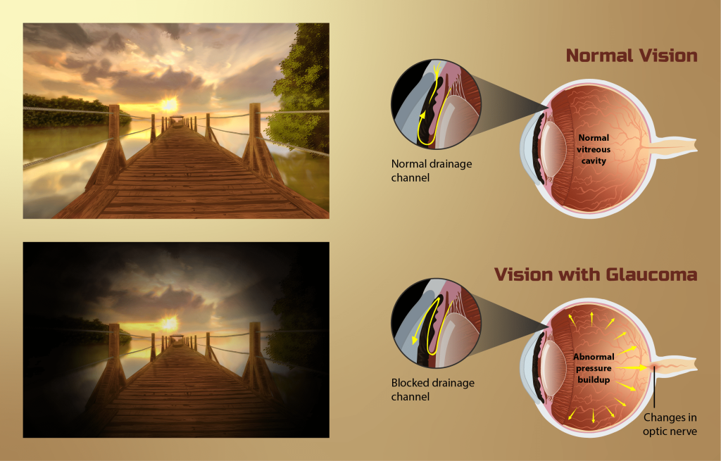 Con qué aparatos medimos la PIO? Glaucoma Parte 2. - Clínica VISIONKER