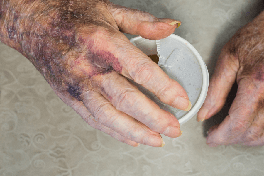 Aging Hands With Bruises And Age Spots