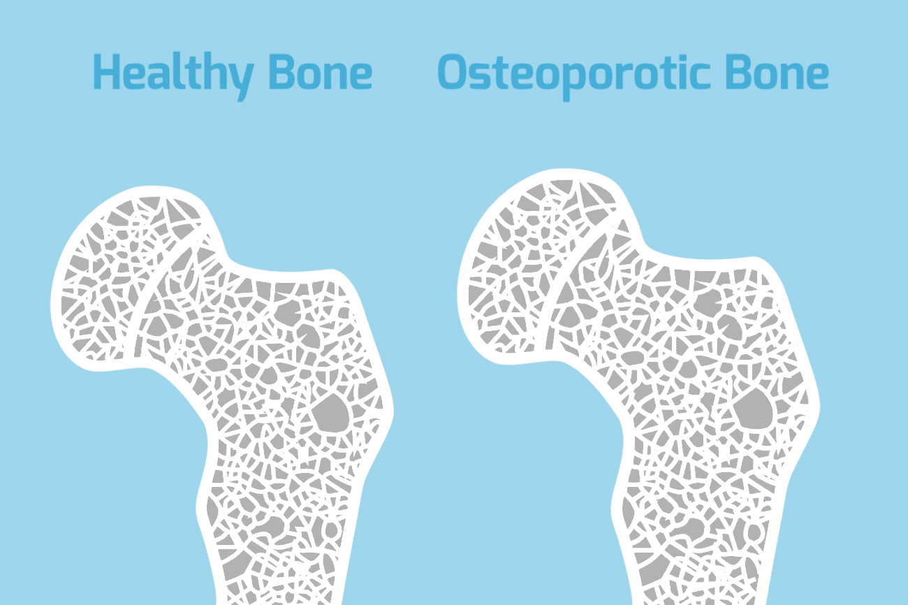 osteoporosis-Prolia-Bone-GIF_Resized_1300x866