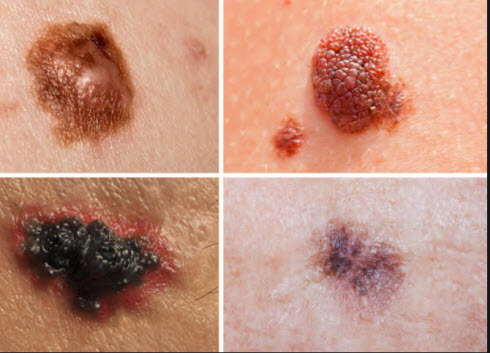 skincare-for-seniors-melanoma-spots
