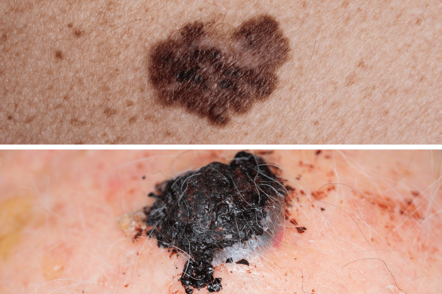 Skin Care For Seniors - Malignant Melanoma Spot And Tumor