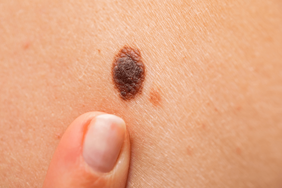 melanoma-or-skin-tag